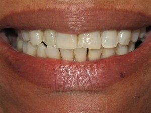 teeth whitening case