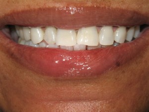 teeth whitening case