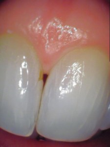 closeup of triangle between teeth