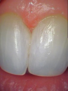 closeup of triangle between teeth