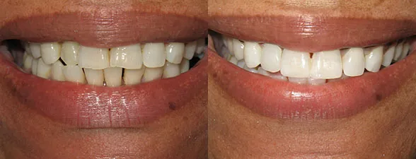 before and after gallery photo