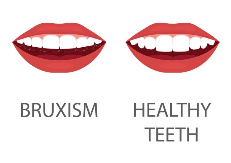 mouthguard illustration