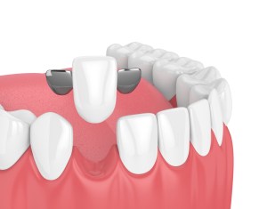 dental bridge illustration