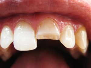 chipped tooth