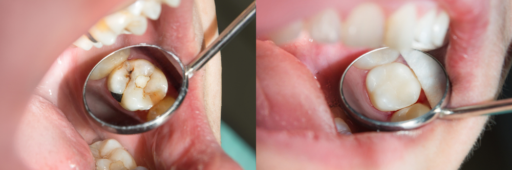 before and after Composite Material has been applied