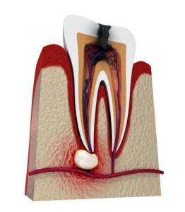 infection or abcess illustration