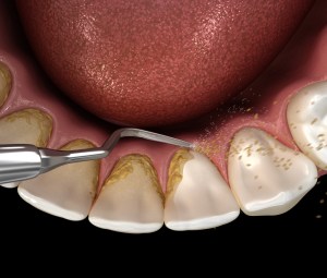 mouth illustration with cleaning tool