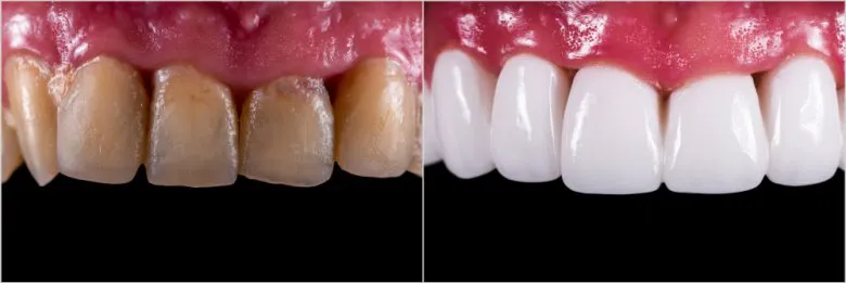 dental crowns before and after photo