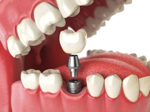 implant illustration