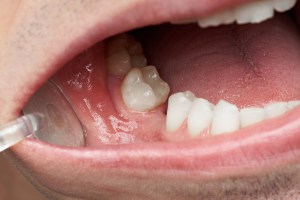 mouth with an extracted tooth space