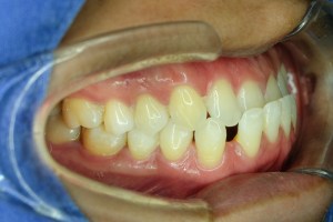mouth with lips pulled back