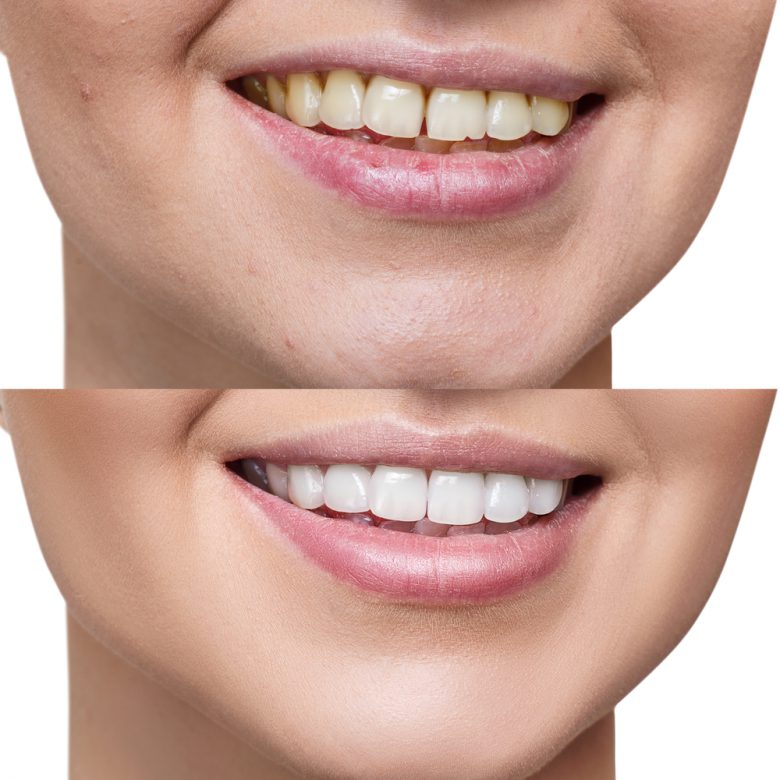 Porcelain Veneers before and after photo